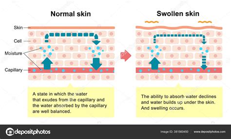 Edema of skin: Edema – Symptoms and causes