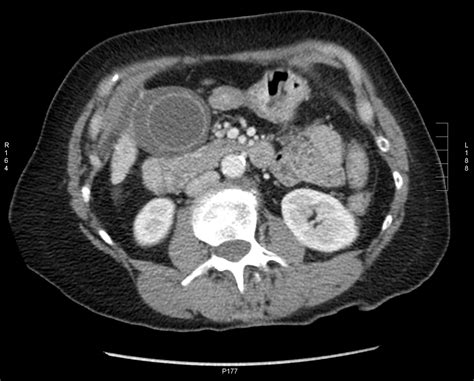 Abdominal CT scan. Causes, symptoms, treatment Abdominal CT scan