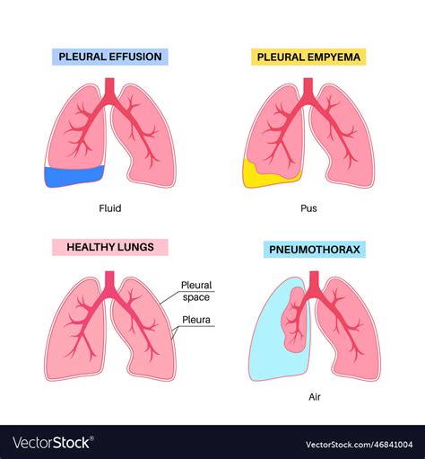 Pleural effusion poster Royalty Free Vector Image