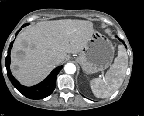 Necrotic GIST Tumor with Increased Vascularity and Liver Metastases ...