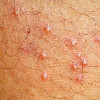 Folliculitis - Dermatologist in Honolulu, HI