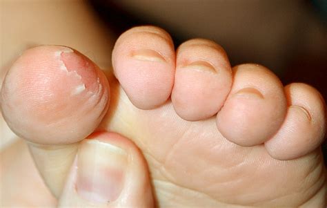 Skin Peeling on Feet - Symptoms, Causes, Treatment, Remedies