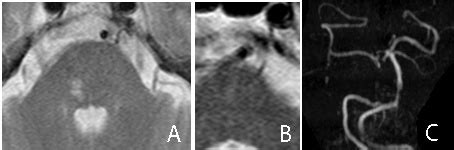 Small deep pontine infarct (SDPI); A: Axial T2WI MRI of the brain shows ...