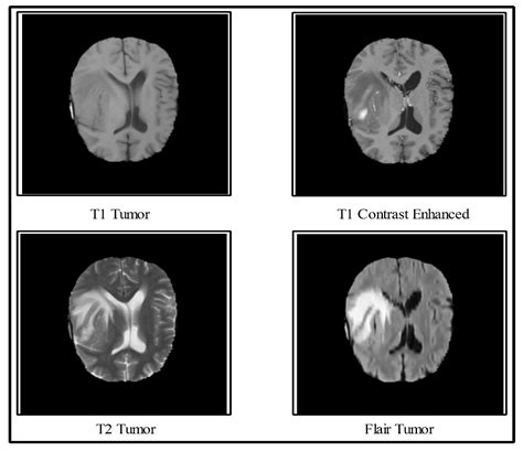 Brain Tumor Color Mri