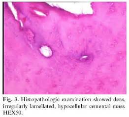 Cementoblastoma Histology