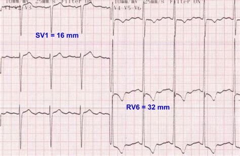 Sokolow-Lyon criteria for left ventricular hypertrophy – All About ...