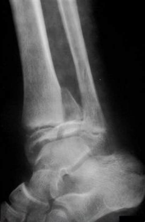 Fracture Education : Evaluation