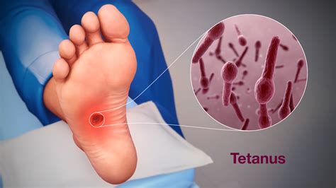 Clostridium Tetani Symptoms