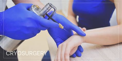 Cryosurgery — Georgia Dermatology & Skin Cancer Center