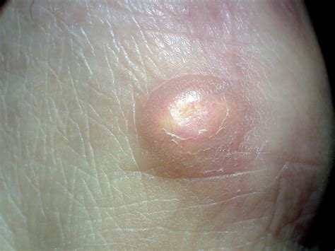 Boil Cyst: Symptoms, Causes, Treatment, 56% OFF