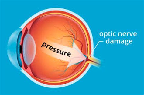 Glaucoma - Roswell Eye Clinic