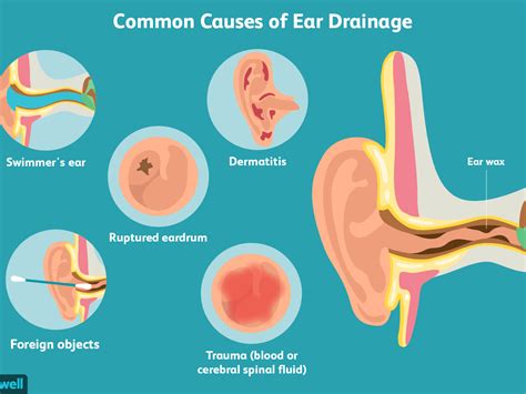 How To Cure Fluid In The Ear - Vastexamination2