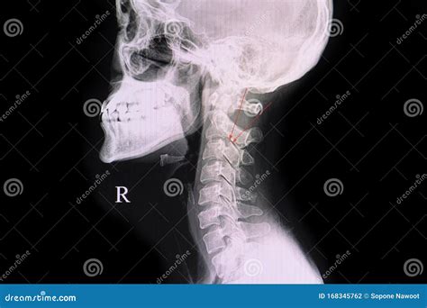 Fracture Pedicle of Cervical Vertebra Stock Photo - Image of cord ...