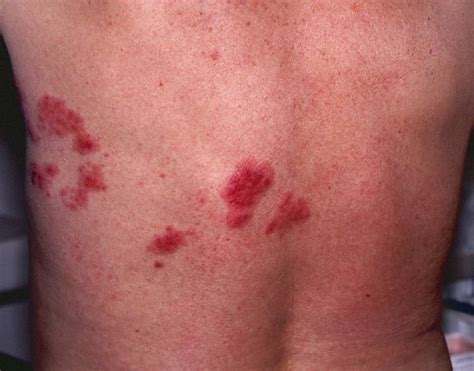 Shingles Rash: Mild, Early Stages, Pictures - eHealthStar