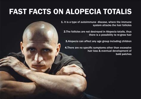 Alopecia Totalis - Symptoms, Causes, Treatment & Prevention | RichFeel