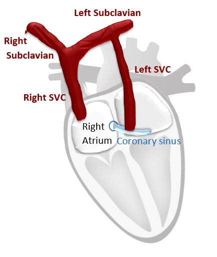 Persistent Left Superior Vena Cava (PLSVC): Anatomy and blood flow ...