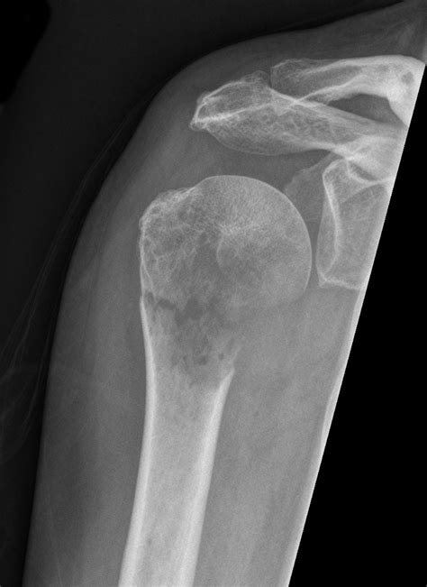 Rt shoulder - pathologic fracture - metastases | Radiology, Medical ...