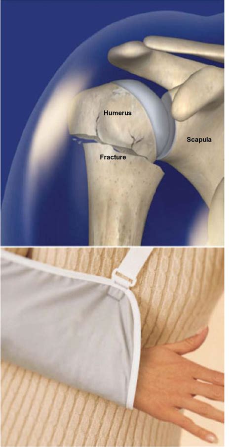 Left Humerus Fracture