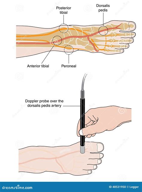 Doppler Probe Measurement Of Pedal Pulse Stock Vector - Image: 48531950