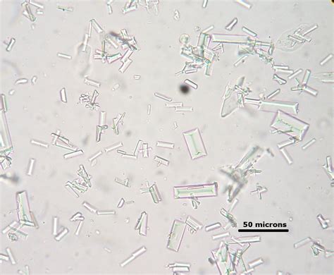 Calcium Oxalate Dihydrate Crystals In Urine