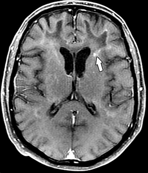 Adult Leukodystrophies: A Step-by-Step Diagnostic Approach | RadioGraphics