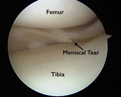 Knee Anatomy Torn Meniscus