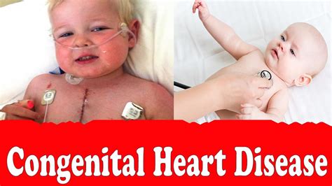 What is Congenital Heart Disease - Types, Causes, and Symptoms