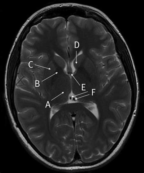 Mri Anatomy Brain Axial Image 220 Brain Anatomy Mri Brain Brain Images ...