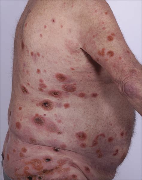 Fatal Cytotoxic Cutaneous Lymphoma Presenting as Ulcerative Psoriasis ...