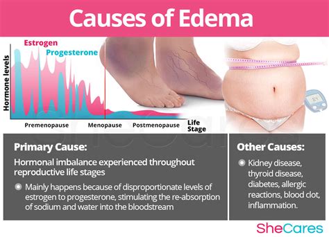 Edema | SheCares