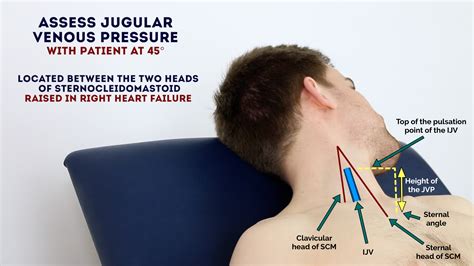 Jugular Venous Pressure Measurement