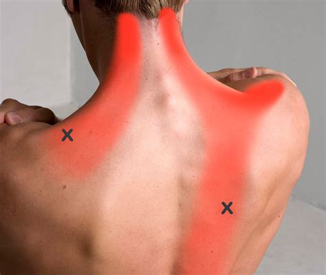 About Our Trigger Point Therapy Trigger Point Myotherapy