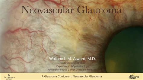 Neovascular Glaucoma - YouTube