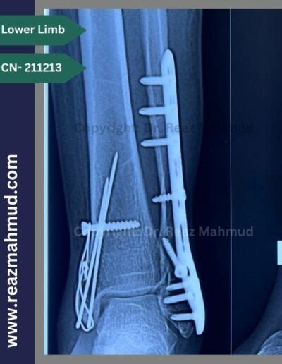 Bimalleolar Ankle Fracture | ORIF [CN-211213] - Dr. Reaz Mahmud