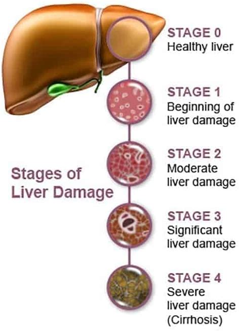 Liver Cirrhosis Stages