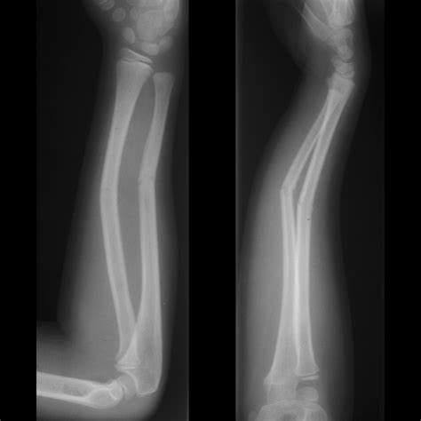 Greenstick Fracture X Ray