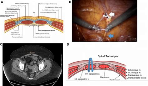 Anatomy below the arcuate line and location of the spiral technique ...