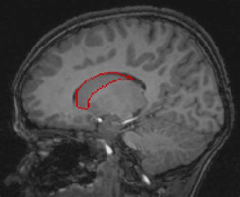 MRI Scan of caudate nucleus. The sagittal MRI scan shows a ...