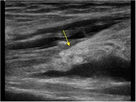 Musculoskeletal Joints and Tendons | 6.1 Shoulder : Case 6.1.2 Biceps ...