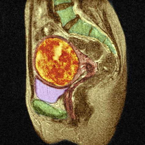 Large Fibroid Uterus Surgery