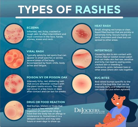 Allergic Rash (... - Dr CAJ Thompson & Dr M De Villiers