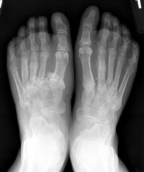 Differential diagnosis of Charcot arthropathy | Lower Extremity Review ...