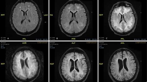 MRI Scans Show The Horrific Effect Cocaine Abuse Can Have On Your Brain ...