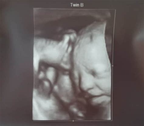 30 weeks pregnant 3d ultrasound - Qaslava