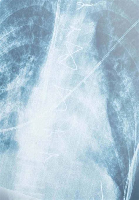 Thyroid Cancer Metastasis To Lung Symptoms