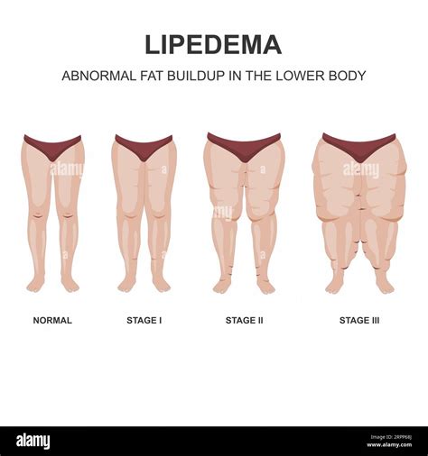 Lipedema stages illustration Stock Photo - Alamy