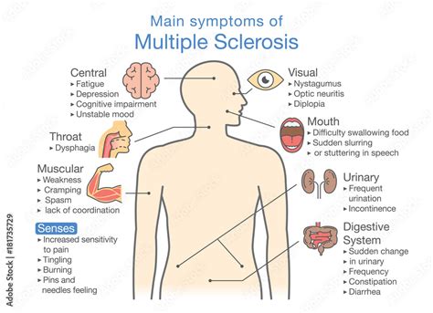 Main symptoms of Multiple Sclerosis. Illustration about medical diagram ...