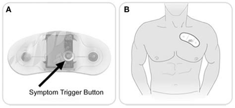 Ziopatch cardiac monitor. Zio Patch button and placement. (A) Patients ...