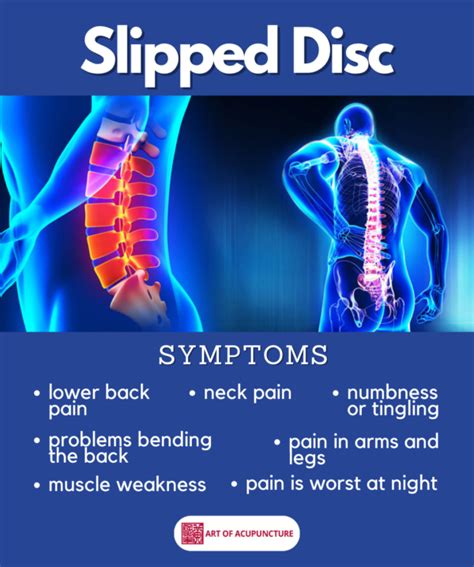 Slipped Disc Symptoms - Art of Acupuncture