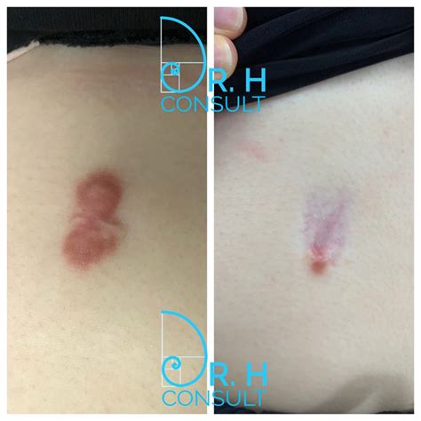 Keloid Scar Treatment / Removal London & Surrey | Dr H Consult